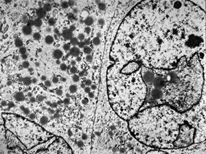 M,64y. | liposarcoma v.s. M,64y. | liposarcoma v.s.